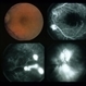 Eales Disease Eales Disease